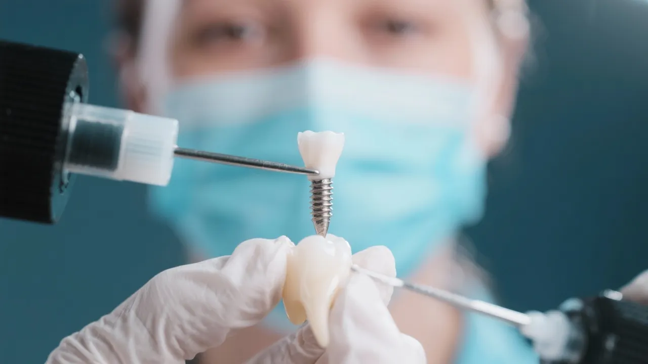 A Comprehensive Guide to Dental Implants