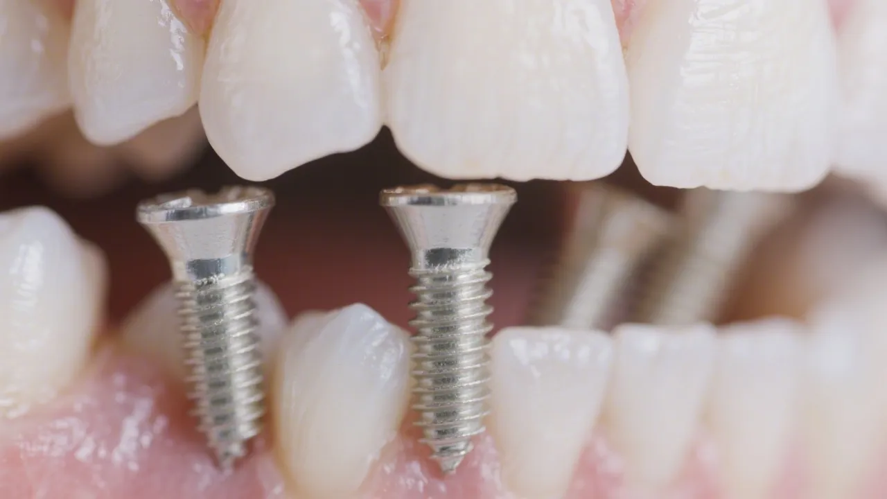 New Teeth Now Nearby: A Comprehensive Guide