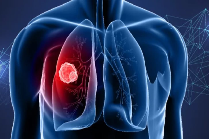 Managing Lung Cancer: Dealing with Cough and Chest Pain