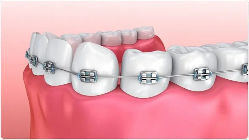 Everything You Need to Know About Dental Braces and Teeth Alignment